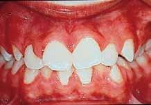 Full Size Twin Brackets Figures 7, 8, 9 show a patient with large teeth, a