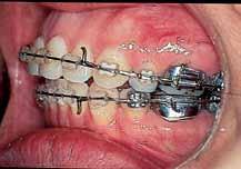 If all four bicuspids are the same size, then first bicuspid brackets can be placed on both first and second bicuspids.