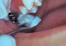 bracket a specific number of millimeters from the incisal or occlusal tooth surface.