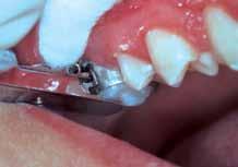 Incisal or occlusal fractures and wear, as well as teeth with extremely tapered and pointed cusps, led to bracket placement errors.