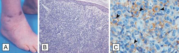 Figure 4. Histopathologic features of a primary cutaneous diffuse large B-cell lymphoma leg type (PCLBCL LT) patient with programmed death-1 (PD-1) + neoplastic B cells.