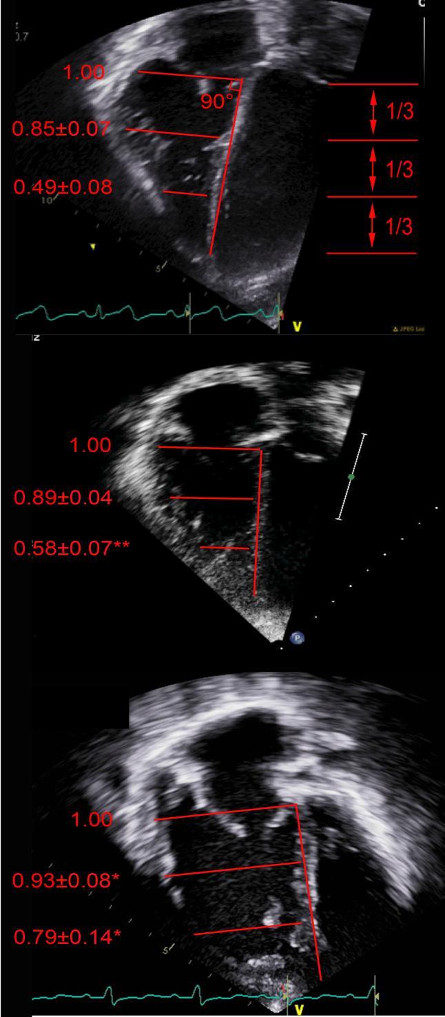 RV apical remodeling Control Pulmonary stenosis