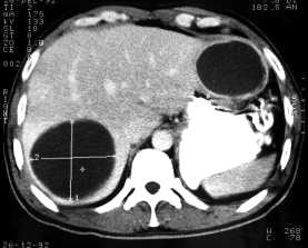 Cystic lesions of the liver Liver abscess [Pyogenic] Frequently indolent with no signs of infection May present with profound septicemia Microabscesses