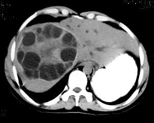 Cystic lesions of the liver CT FEATURES TO DIGNOSE HYDATED CYST Other cysts specially in the lung Unilocular