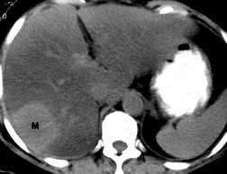 Hepatocellular carcinoma CT Single or multiple masses that are hypo
