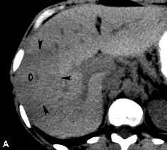 Focal nodular hyperplasia FNH 8% of all hepatic tumours 2 nd most