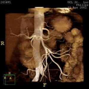 Detailed examination of the Superior Mesenteric Artery and