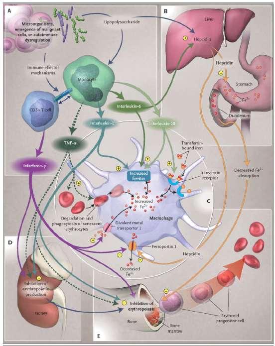 Impaired erythrogenesis The anaemia of chronic disease