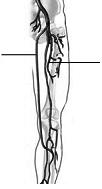 Marilyn Ollett Department of Surgery Christchurch Hospital ARTERIAL BYPASS GRAFTS IN THE LEG Department of Vascular