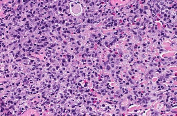 ! CD30+ large atypical cells (50%) Stromal eosinophilia May be clonal (25%) Session 6 - case 159
