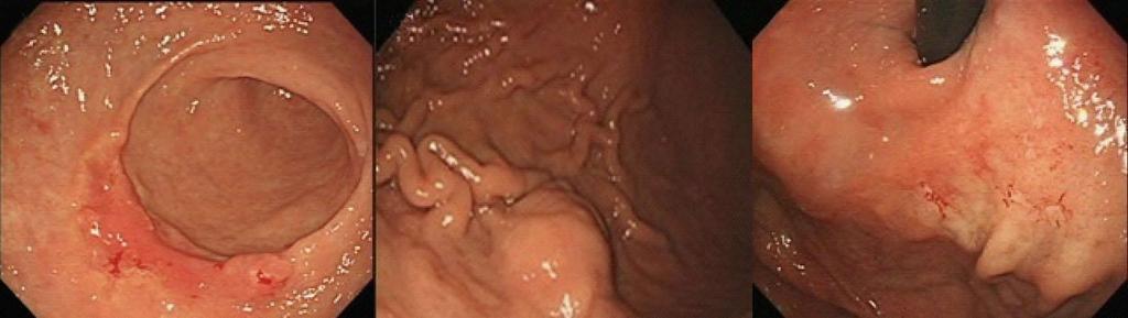 Choi KW et al. Synchronous triple gastric tumor A B C Figure 1 Images obtained during endoscopic examination.