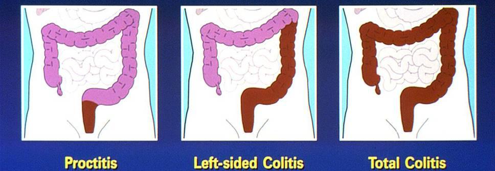 Ulcerative Colitis Disease