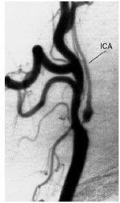 REMEMBER, WE HAVE DISCUSSED RESULTS FOR ONLY THOSE HAVING TIA S AND / OR NON-DISABLING STROKES (RANKIN SCALE 0 2) AS PRESENTATIONS OF THEIR CAROTID ARTERY STENOSIS Benefit of CEA for those having
