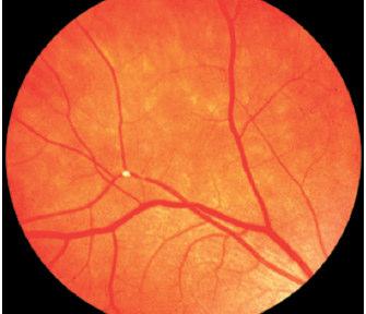 Hollenhorst Plaque and Retinal Artery (or Retinal Artery Branch) Occlusions: Low Risk for Subsequent Hemispheric Neurological Events Only 39% were symptomatic Only 8 percent had carotid stenosis