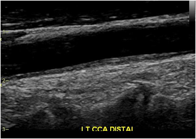 Intima-Media Atherosclerotic Carotid Artery Thickening Provides Some Indication of Risk Due to Coronary Artery Disease Relative Risk for Stroke or Myocardial Infarction as Function of Common Carotid