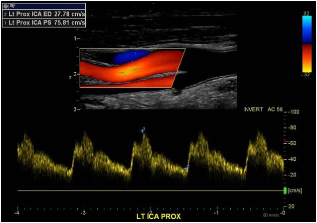 Applicant Demonstrates Findings of Critical (70 99%) Carotid Artery Stenosis Normal ED < 100 cm / sec PS < 125 cm / sec Applicant ED 131 cm / sec PS 427 cm / sec Doppler Criteria for Critical (70