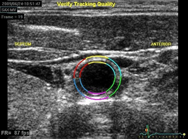 Artery stiffness estimated by 2D speckle tracking technique Current clinical issue Development of accurate, simple and non invasive method Early diagnosis of arteriosclerosis in individuals without