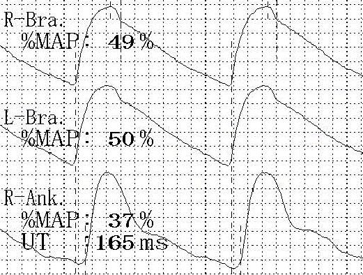 Brachial-ankle pulse wave velocity & Carotid intima-media thickness VP 1000, Colin Waveform analyzer Vivid 7,