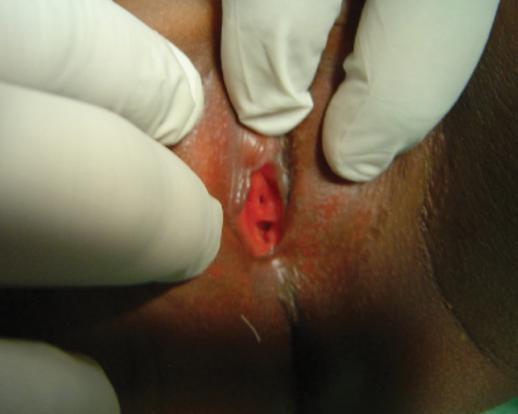 URETHRAL EROSION Female equivalent of catheter hypospadias Leads to