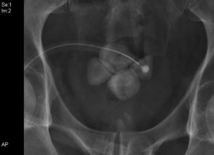 BLADDER STONES Blocking Bypassing Haematuria Pelvic pain Patients with repeated blocking of catheters appear to be