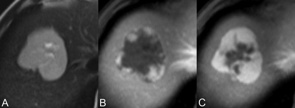 discontinuous arterial-phase enhancement, typical for a cavernous hemangioma, is demonstrated in Fig. 65.2B a breath hold VIBE T1WI obtained one minute following contrast injection.