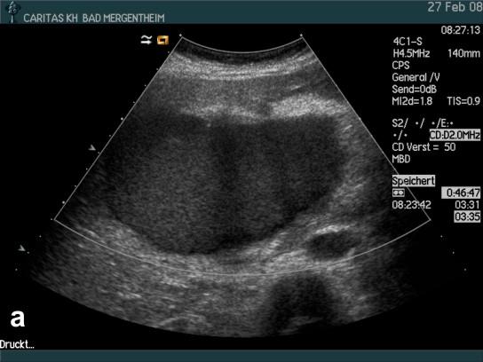 Inclusion Criteria for Study Analysis Inclusion criteria for study analysis were the primarily undetermined cystic pancreatic lesion of any size suspected by transabdominal ultrasound, computed