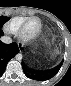 LN disease, other than tumor 5. Mediastinal cysts 6.