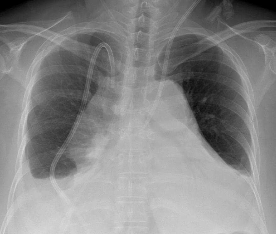 pulmonary artery, and bronchial artery