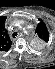 Iatrogenic aortic injury 73/F Focal
