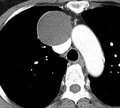 Contents Mediastinal cysts, Common findings 1.