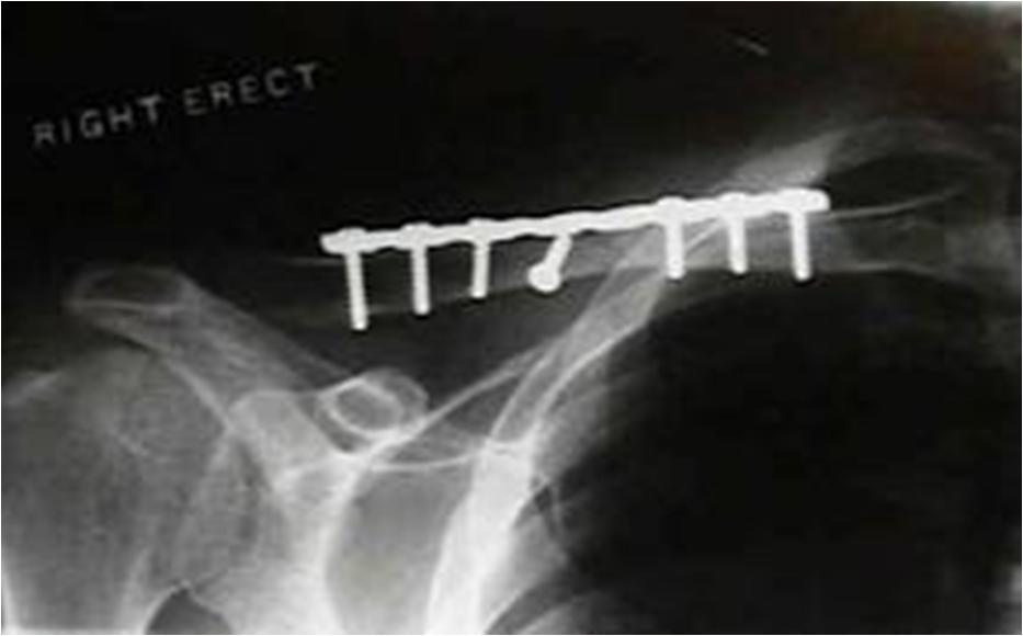 Clavicle fractures operative Tx Outcomes improved functional outcome / less pain with overhead activity faster time