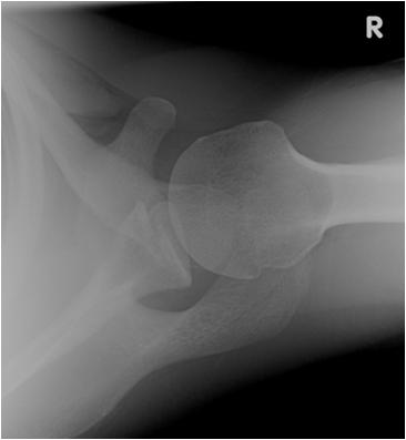 planning humeral head or greater tuberosity position uncertain intra-articular