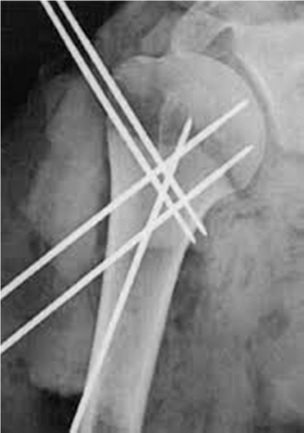 Humerus fractures proximal Operative treatment closed reduction proximal