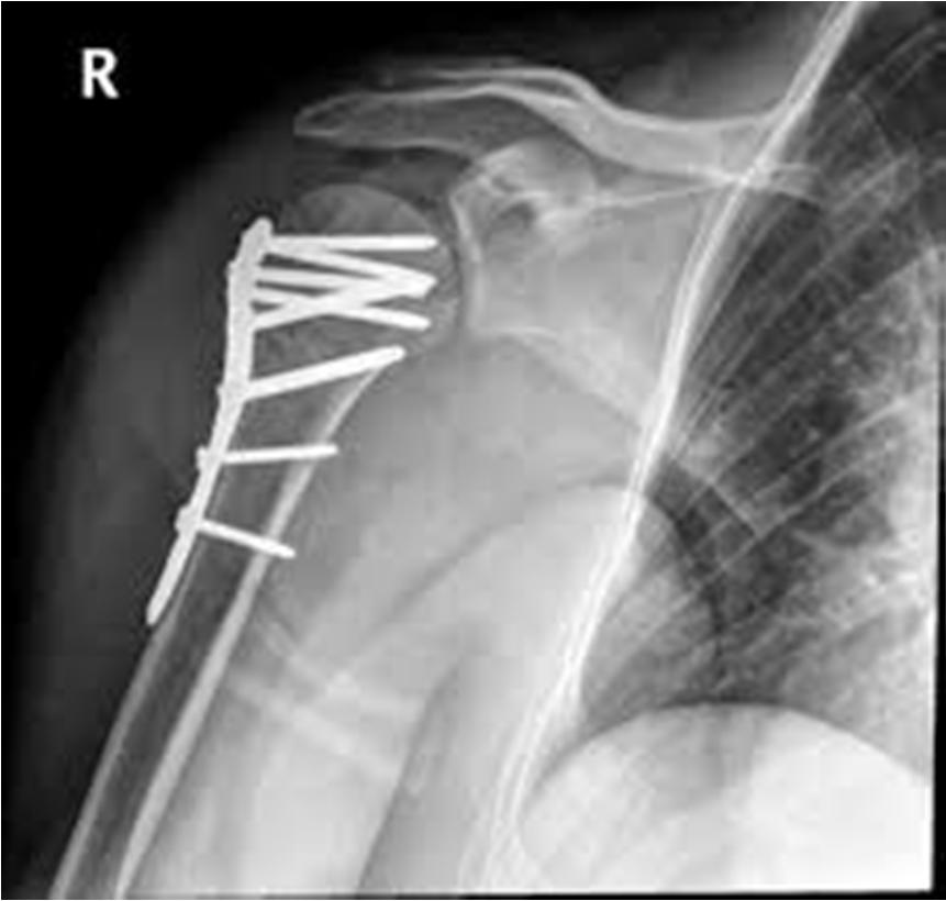 Humerus fractures proximal Operative treatment closed reduction proximal