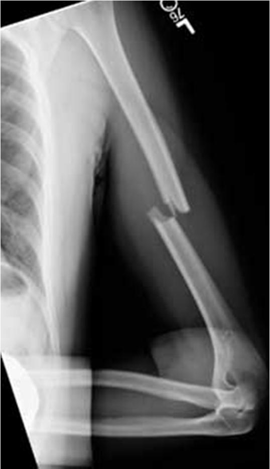 Humerus fractures - shaft Incidence 3-5% of all fractures bimodal age distribution o
