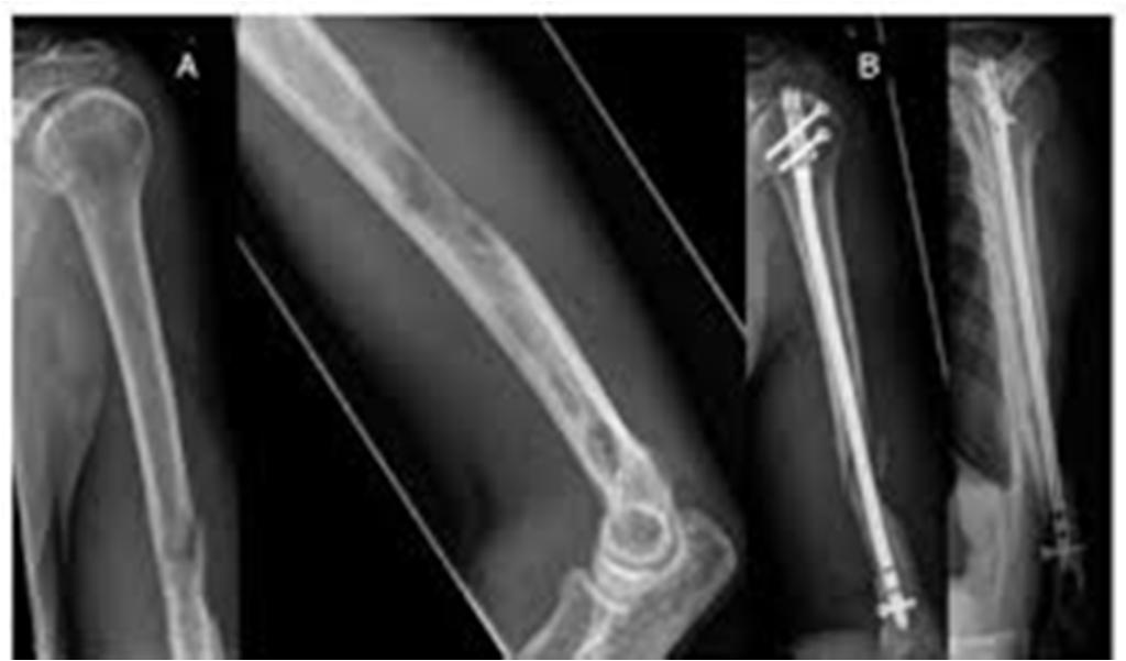Humerus fractures - shaft Operative open reduction and internal fixation o absolute indications open