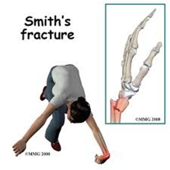 Distal radius fractures Mechanism of injury -
