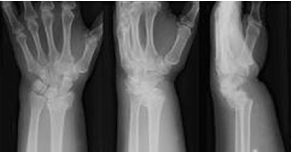 Distal radius fractures Diagnosis Xray - AP and lateral CT - to evaluate intra