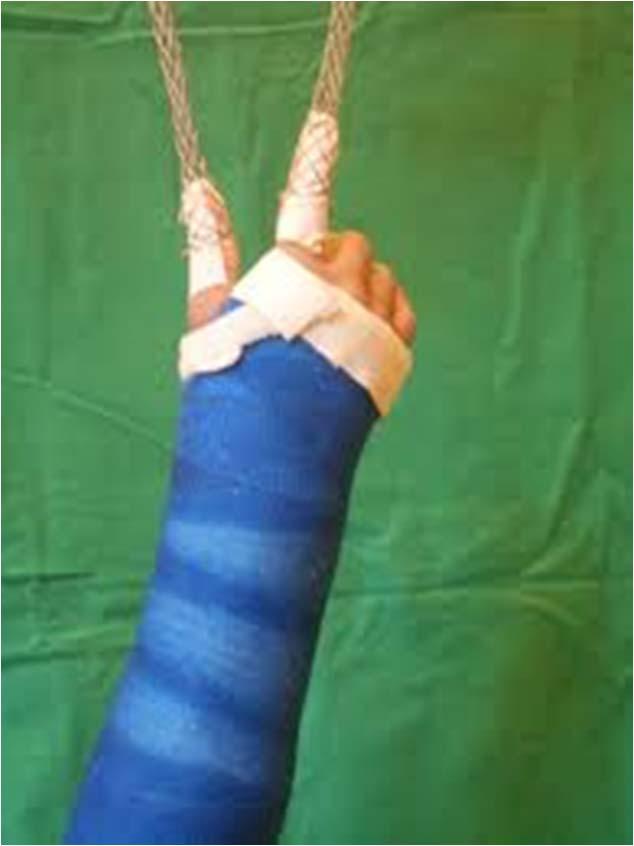 Distal radius fractures Technique bend to the direction of the deformity