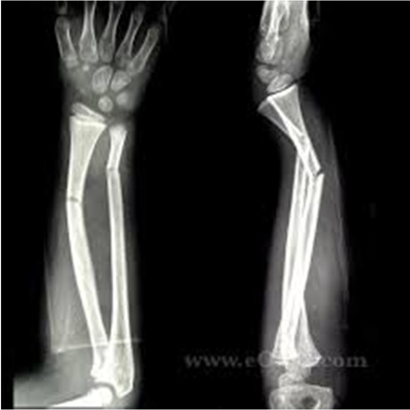 Distal radial fractures pediatric Epidemiology incidence o very common, comprising 45% of all pediatric fractures.