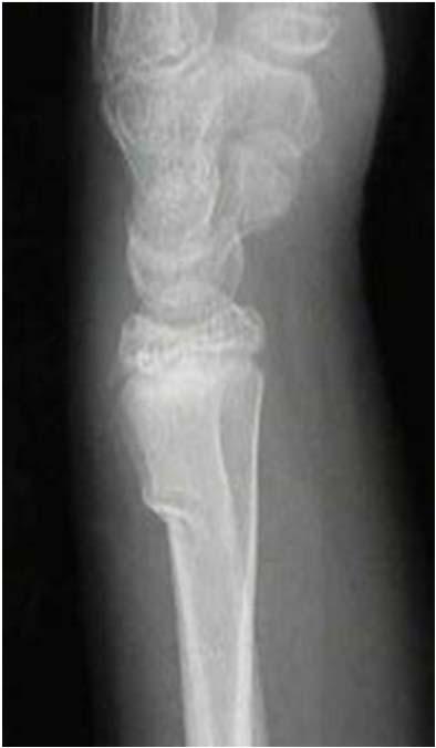 Distal radial fractures pediatric Nonoperative immobolization in short arm cast for 2-3 weeks