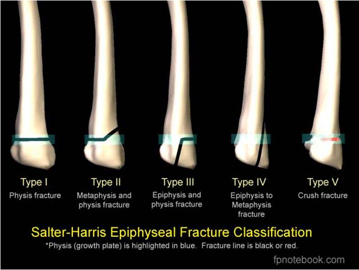 Distal radial fractures pediatric Operative o open reduction and internal fixation indications Salter-Harris III and IV fractures of the distal radial physis both-bone fracture with