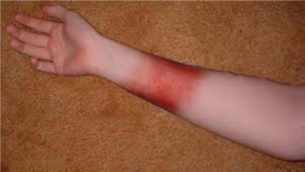 Distal radial fractures pediatric Complications Casting Thermal Injury if o dipping water temperature is > 24C (75F) o more than 8 layers of plaster are used o