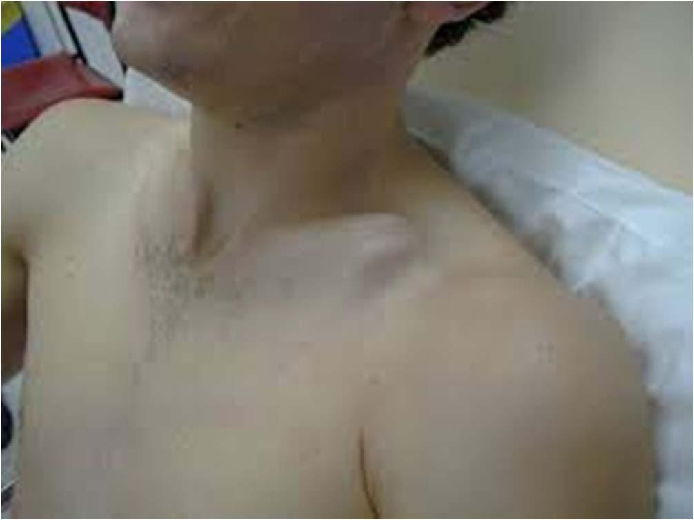Clavicle fractures Symptoms o shoulder pain Physical exam o