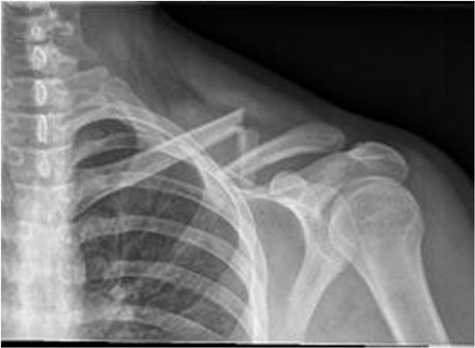 Clavicle fractures Radiographs o standard AP view o 45 cephalic tilt determine superior/inferior displacement o 45 caudal tilt determines AP displacement CT o