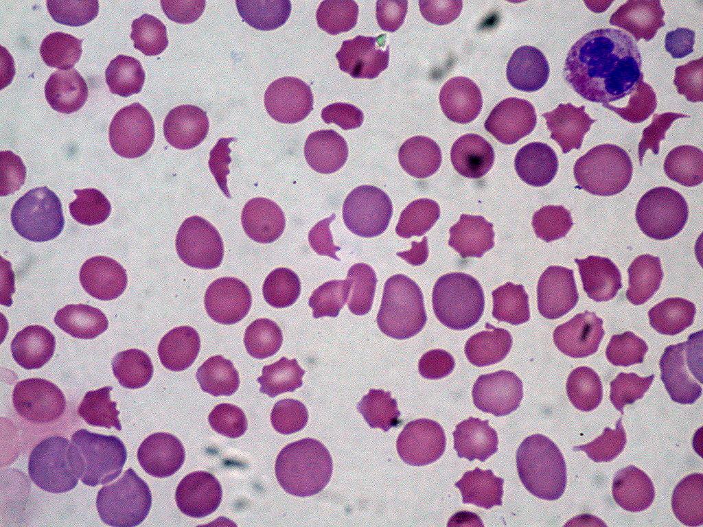 Hemolytic anemia High LDH Low Haptoglobin High indirect
