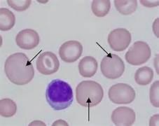 Macrocytosis 6 MCV > 100 Reticulocyte count > 2% Response to blood loss Response to hemolysis Normal