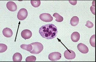 Vitamin B12 (cobalamin) deficiency Low or normal reticulocyte count Pancytopenia
