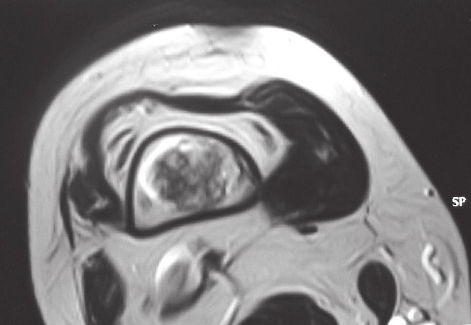 Coronal T2-weighted MR image of the right distal femur, showing an intramedullary, lobulated heterogeneous lesion with high and low signal intensities. c Fig. 1c.
