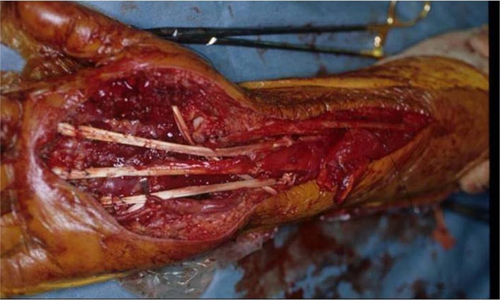 WORLD JOURNAL OF SURGICAL ONCOLOGY Intraoperative extracorporeal autogenous irradiated tendon grafts for functional limb salvage surgery of